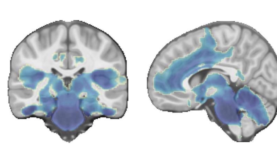 Coronal and sagittal brain scans showing the DMG network highlighted in blue across the brainstem and thalamus